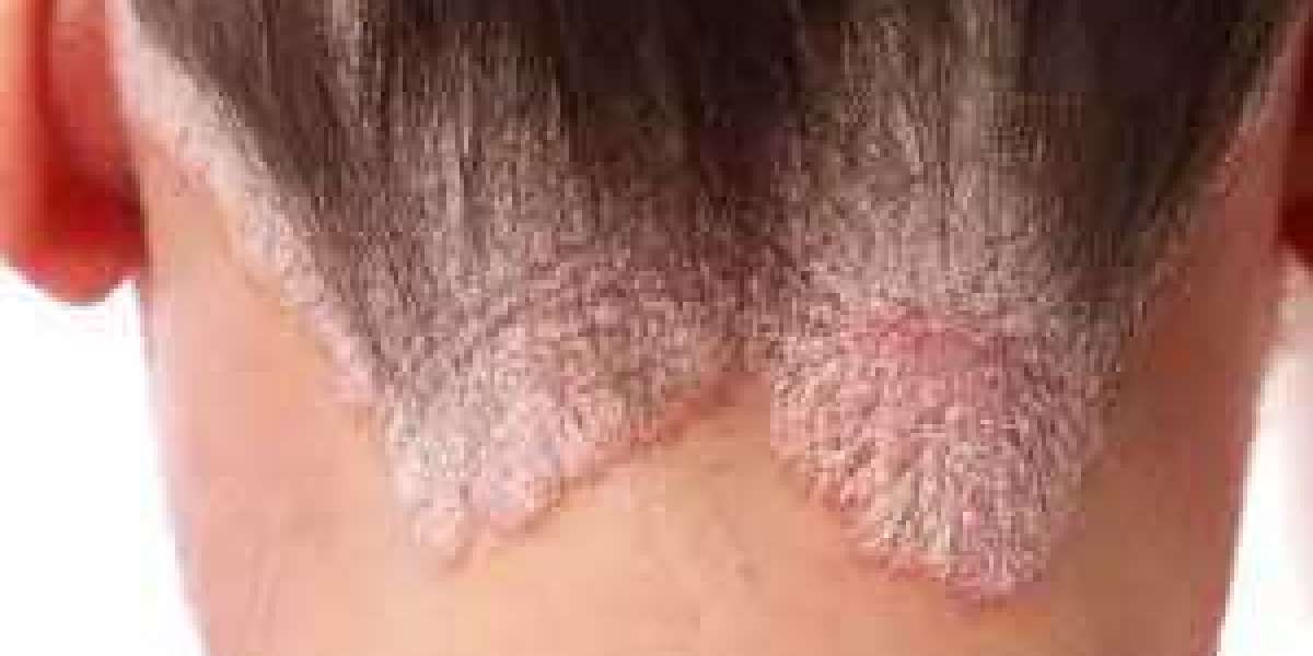 Psoriasis: Debunking Common Myths vs. Facts