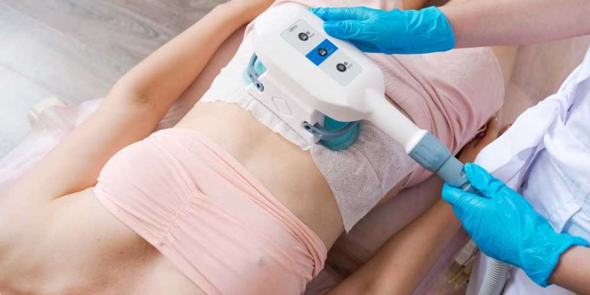 How CoolSculpting Enhances Natural Body Contours