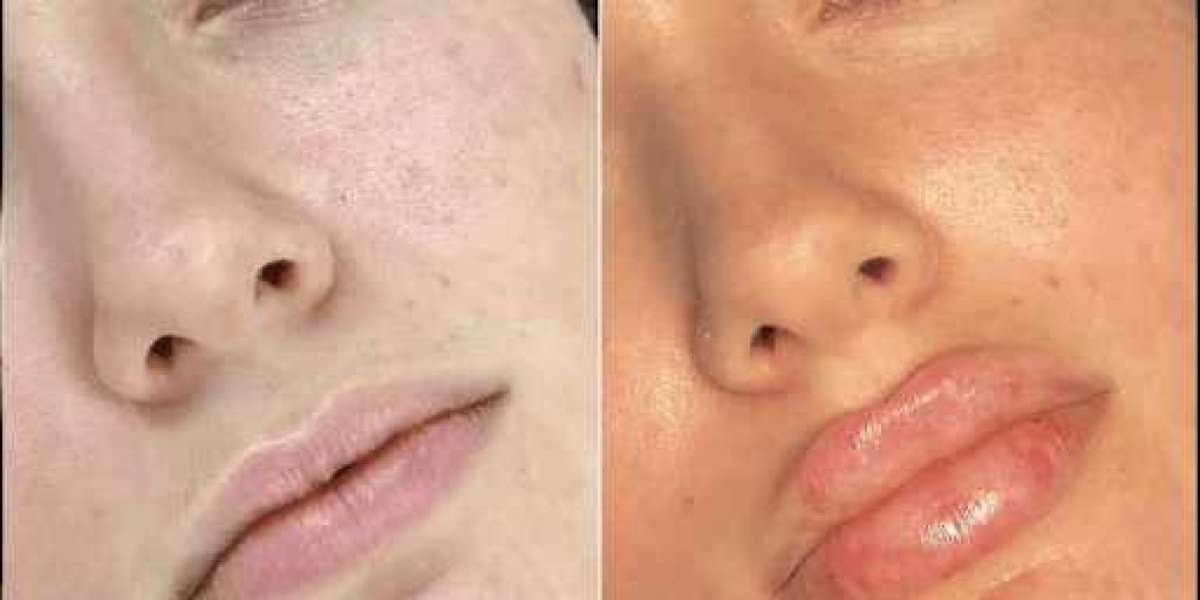 Best Plastic Surgeon in dubai for Fillers for Natural Contours