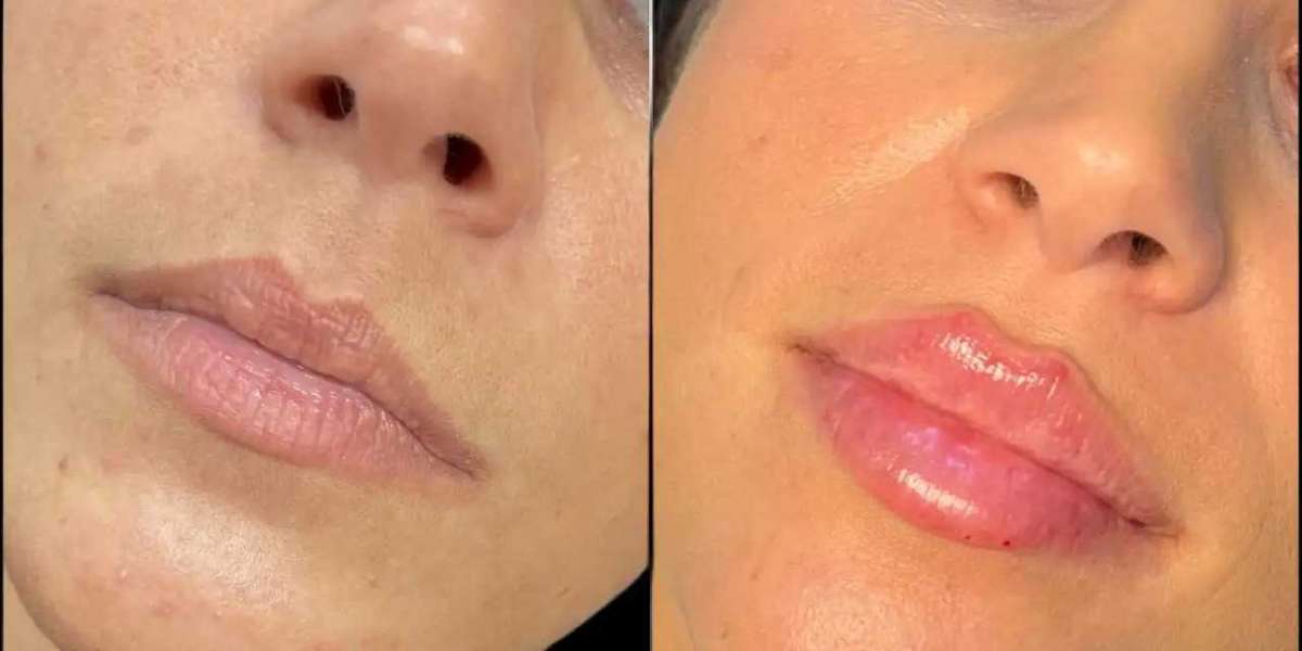 Best Aesthetic Clinics in Dubai for Dermal Fillers to Boost Confidence