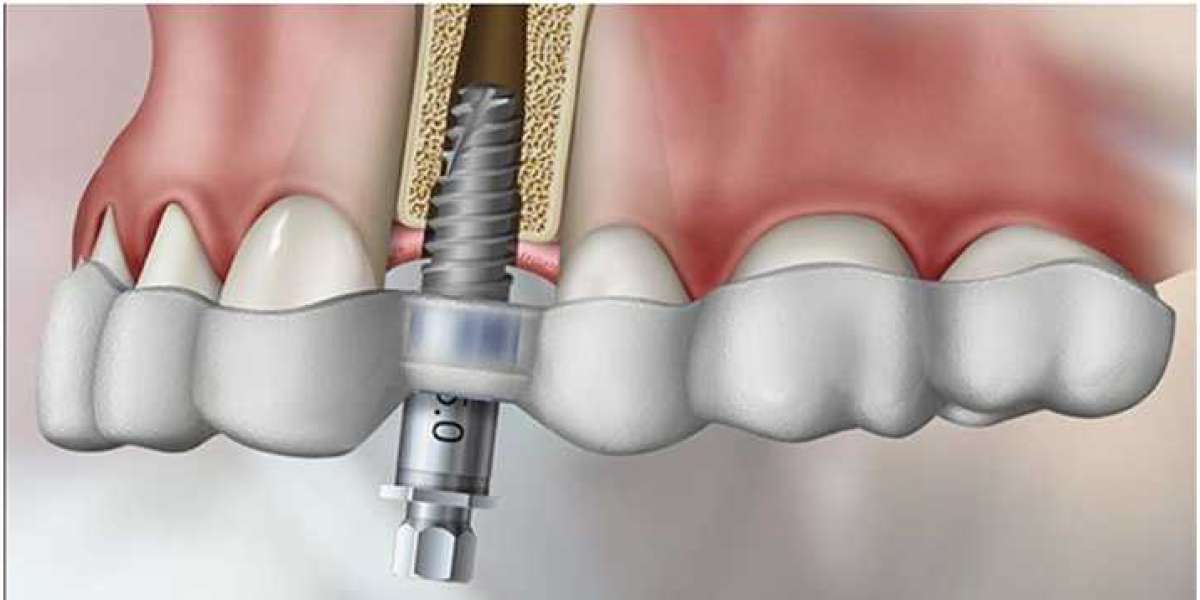 Why Choosing a Norcross Dental Clinic Matters for Your Oral Health – Discover Quality Care at Berkeley Lake Dental
