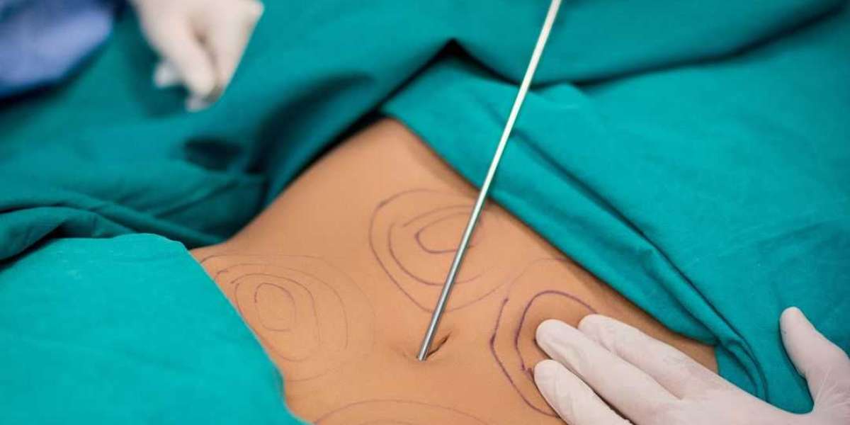 Liposuction in Islamabad – Achieve Your Ideal Body Contours