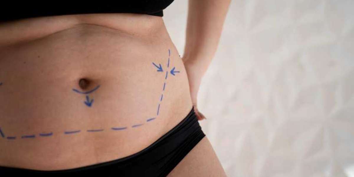 Is Vaser 4D Liposuction the Secret Tool for a Sleek and Muscular Body Look