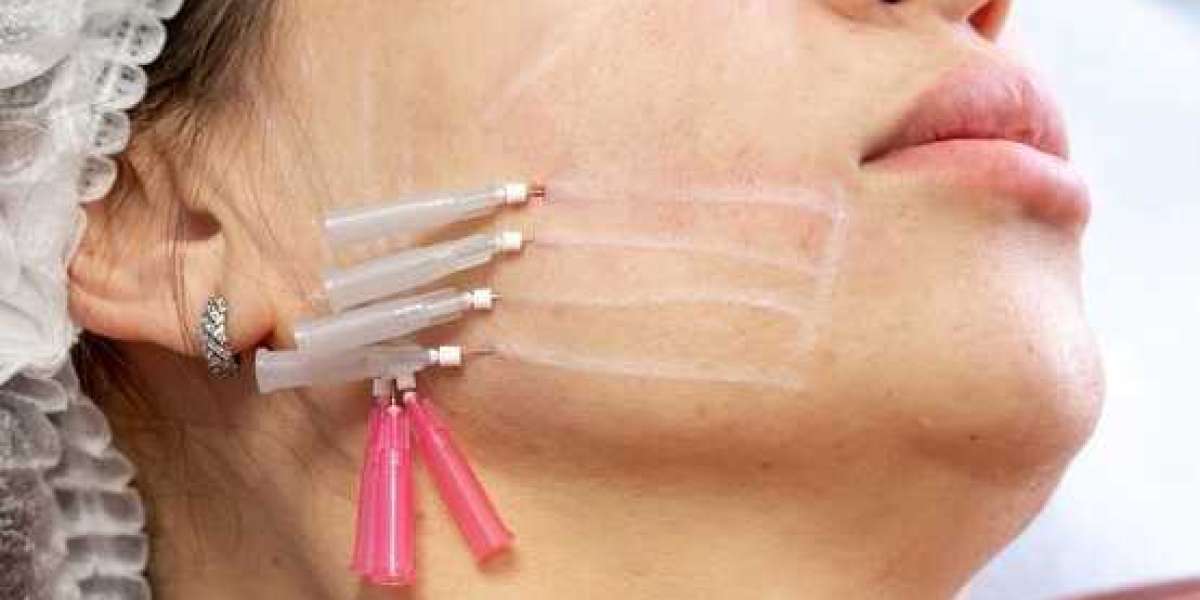 Look Younger Today: Thread Lift Islamabad