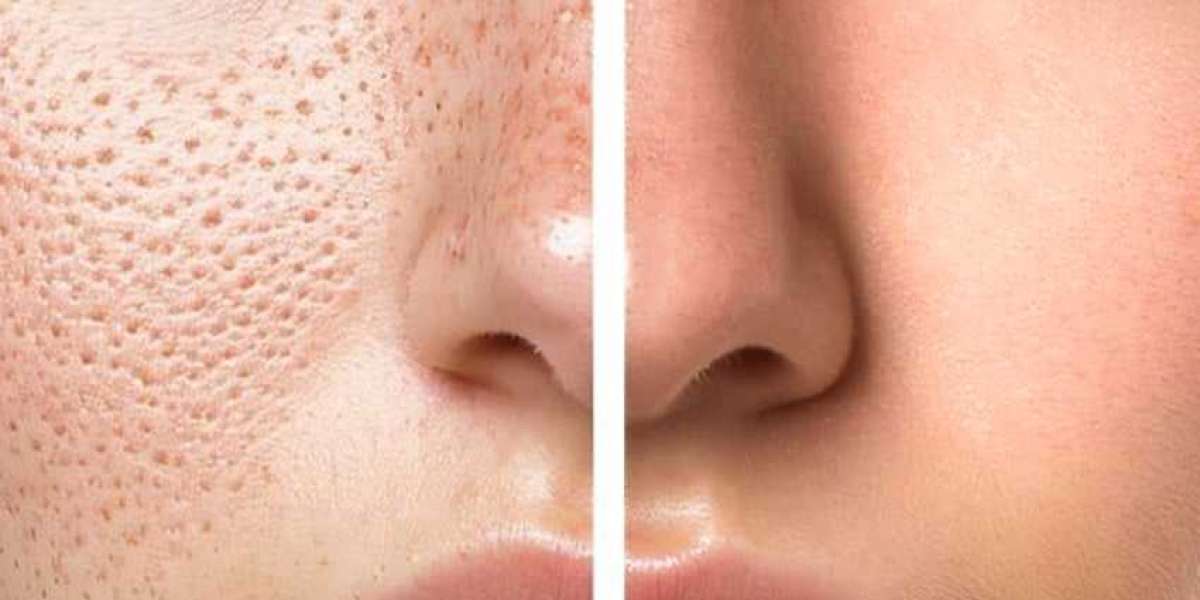 Large Pores Treatment Cost: What to Know About Treatment Pricing