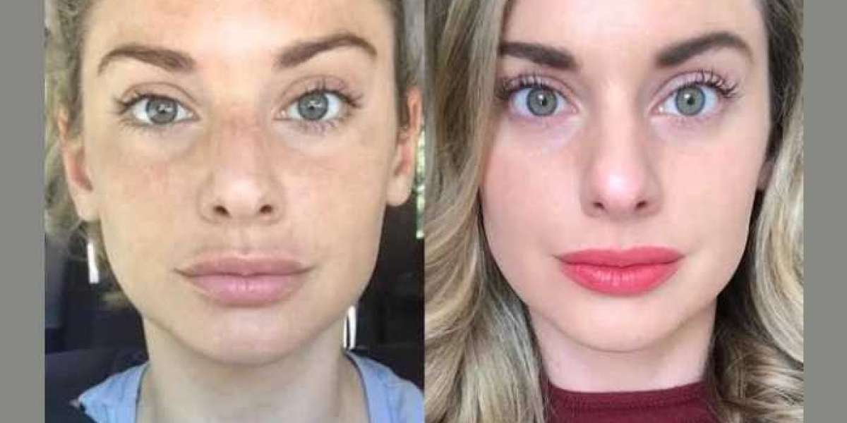 Precision Skin Tightening with Radiofrequency Microneedling Treatments in Dubai