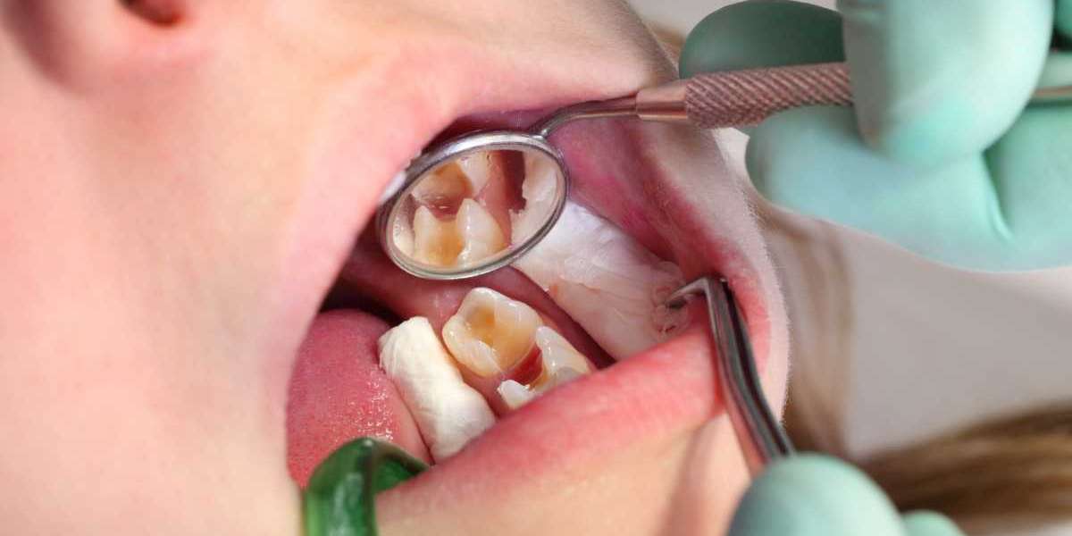How a Dental Tooth Filling Restores Tooth Function