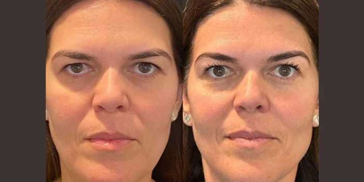 What Is a Thread Lift in Dubai? A Complete Beginner’s Guide