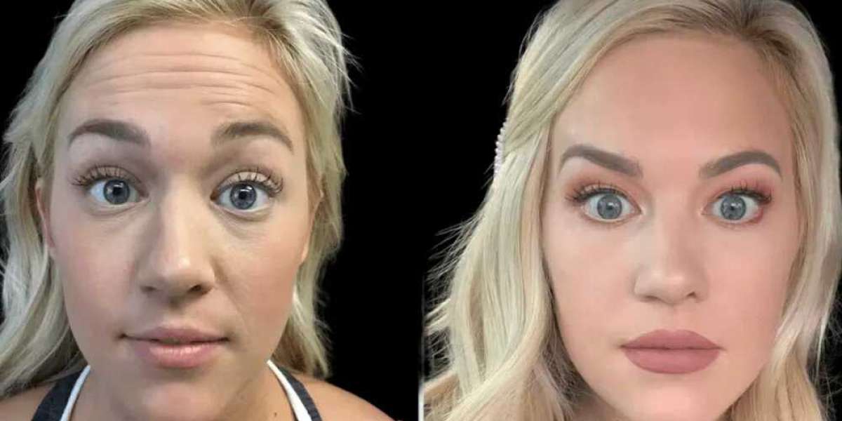 Latest Innovations in Botox Treatment in Dubai You Need to Know