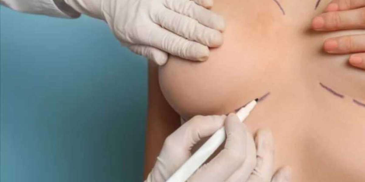 MIA Breast Implant in Dubai – Customized Treatment for Every Woman