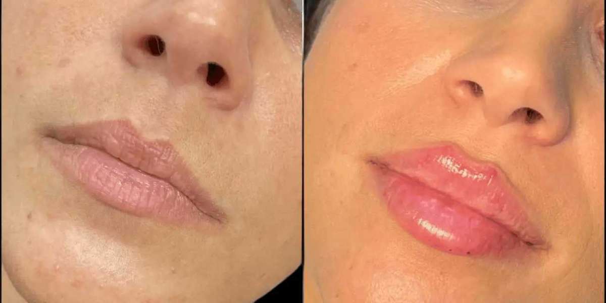 Best Aesthetic Clinic in dubai for Russian Lip Fillers Using Premium Dermal Fillers