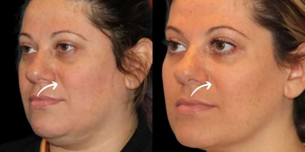 Luxury Skin Sculpting with Sculptra in Best Aesthetic Clinics in Dubai