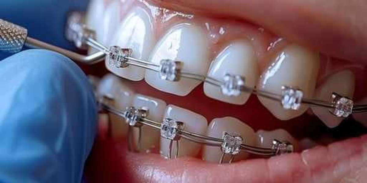 Smile Brighter with Dental Braces in Islamabad