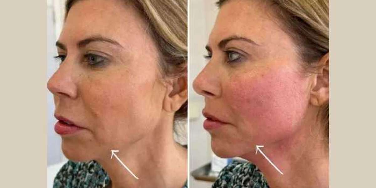 Best Plastic Surgeons in dubai achieving natural results using Endolift