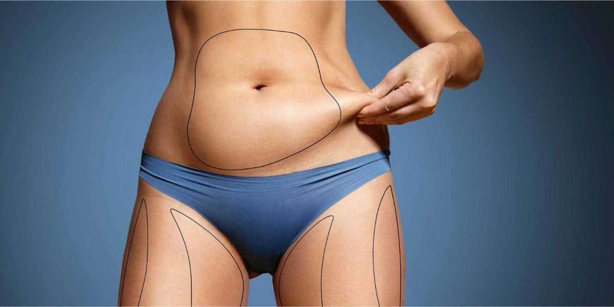 What Is the Recovery Process Like After Abdominoplasty Dubai?