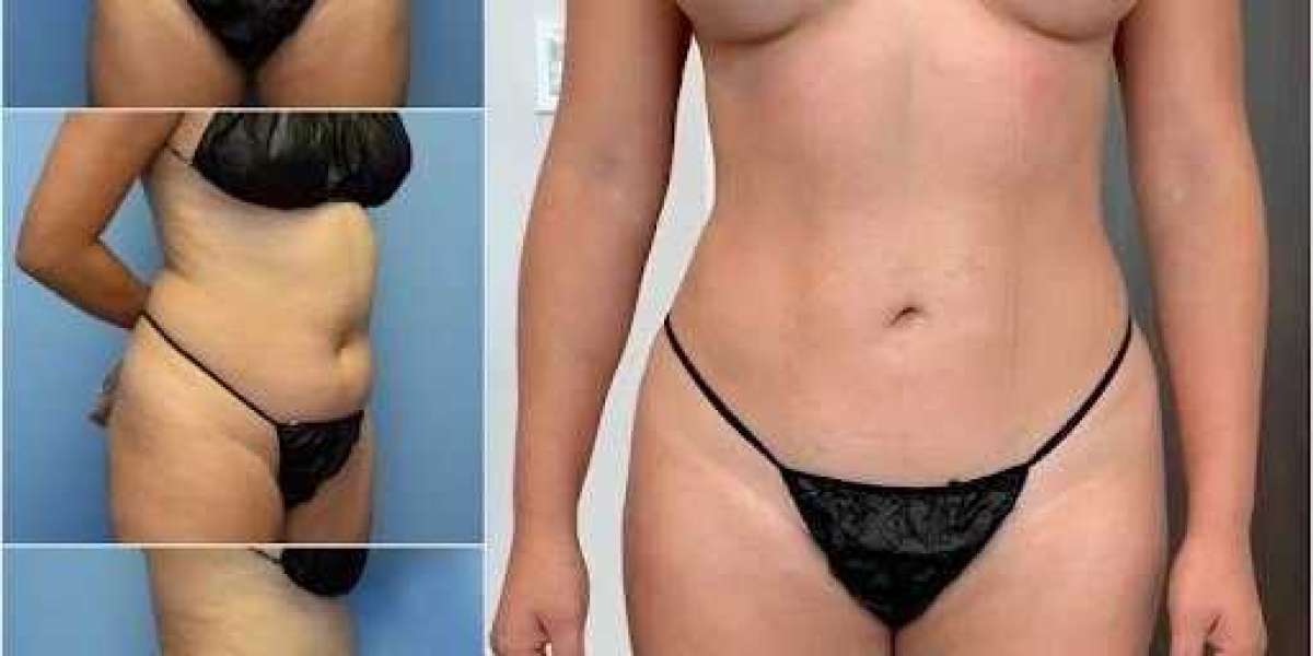 Best Doctors in Dubai for Body Contouring: Achieving Natural Aesthetic Results