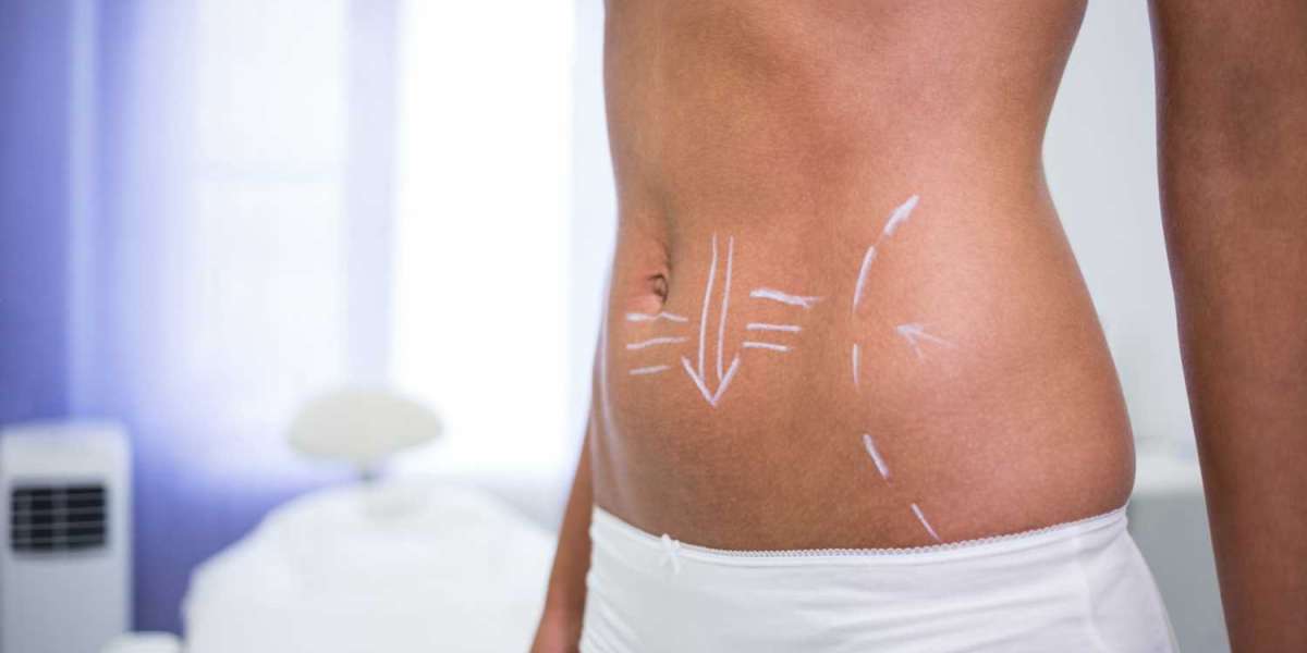Mini Tummy Tuck Dubai vs Full Tummy Tuck: Which One Do You Need?