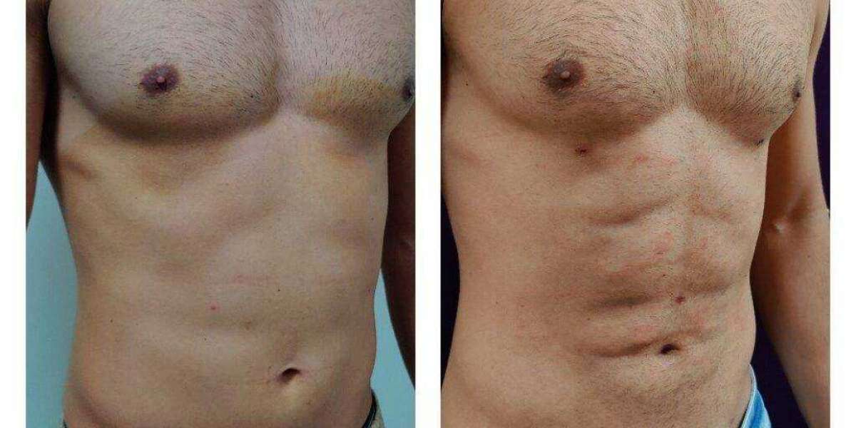 The Modern Man’s Guide to Precision Sculpting: Why Vaser Liposuction in Dubai is a Game-Changer