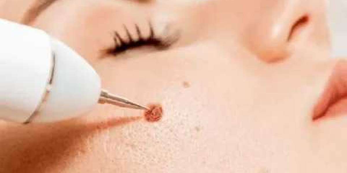 Mole Removal Treatment in Islamabad – Professional Care at Enfield Royal Clinic Islamabad.