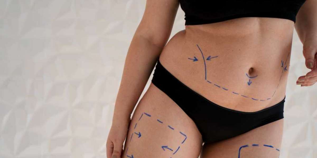 Liposuction in Dubai: A Complete Guide for First-Time Patients