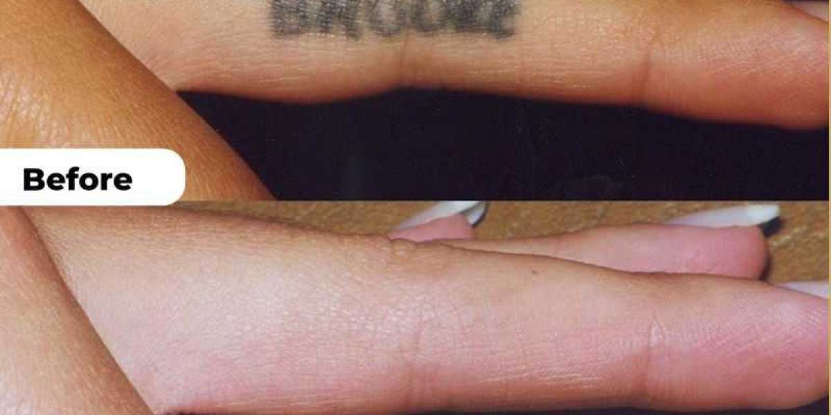 Benefits of Laser Tattoo Removal in Islamabad