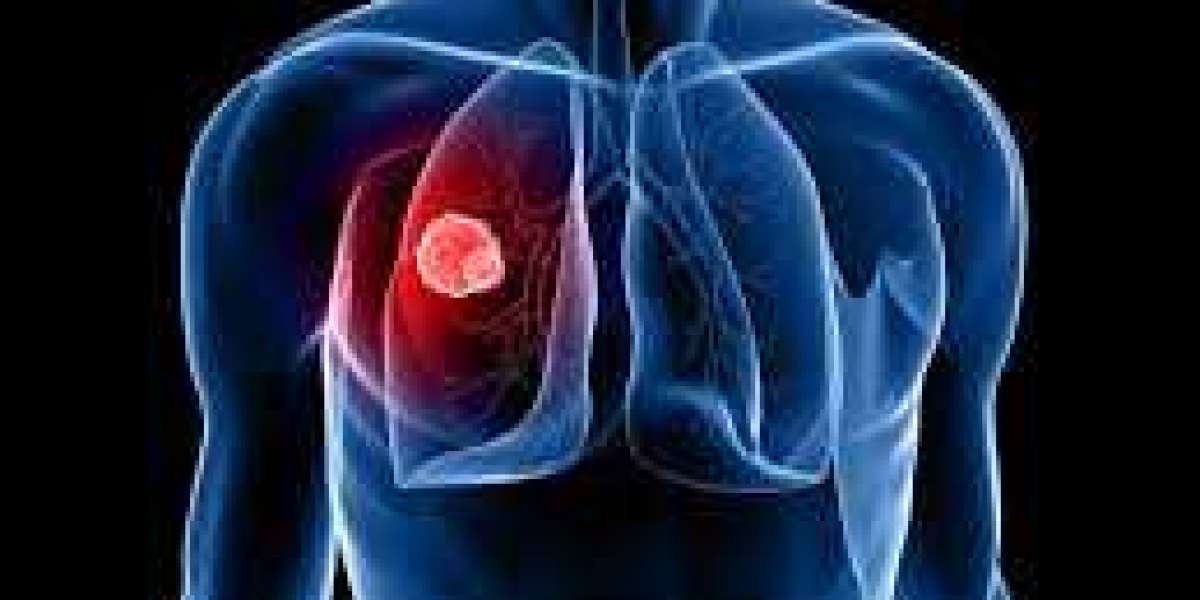 The Lung Cancer Screening Program Wollert Early detection begins with Northside Imaging