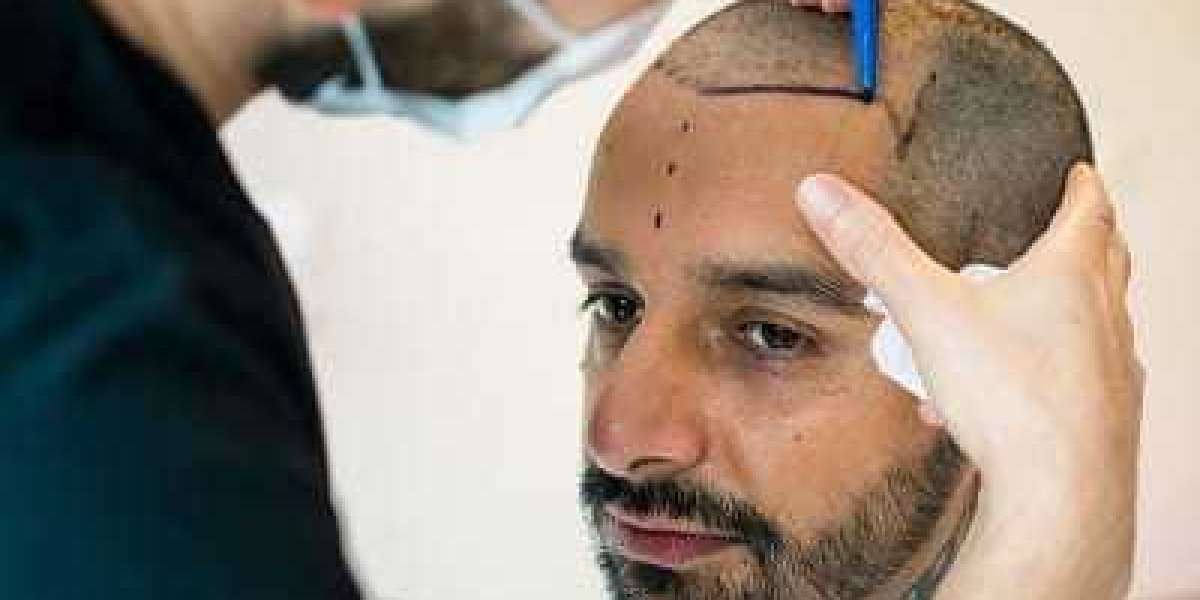 Hair Transplant in Islamabad – A New Beginning for Your Confidence