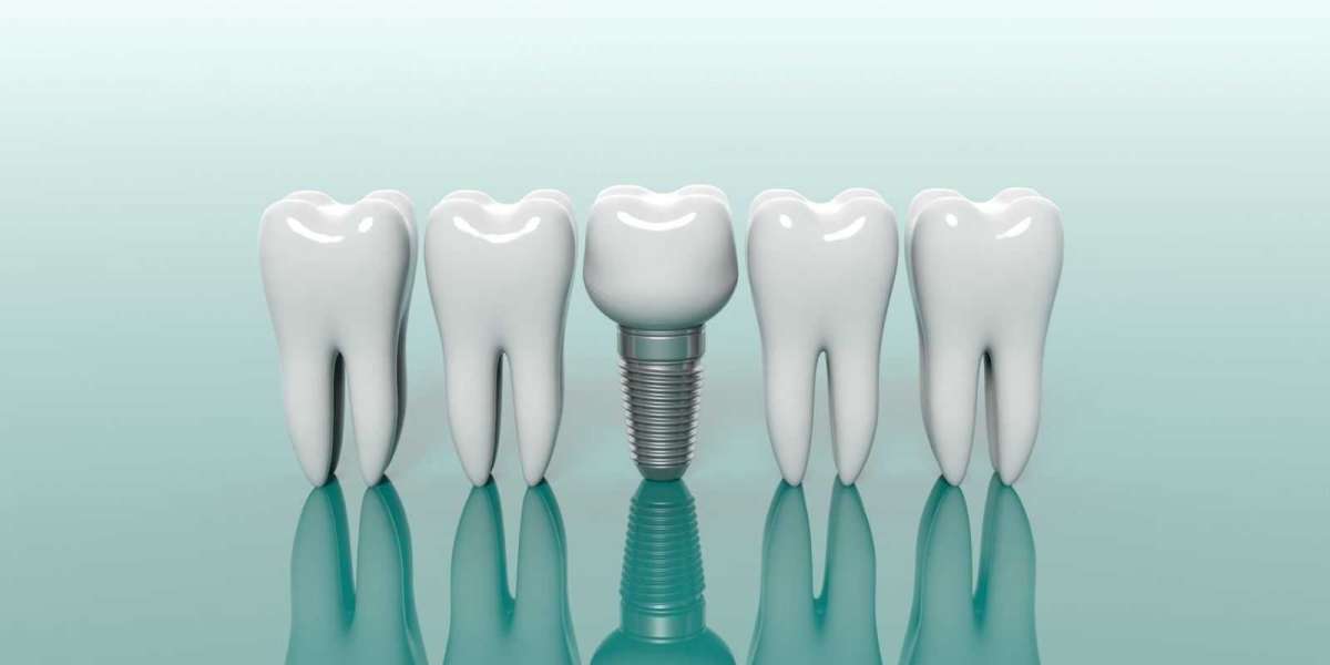 Dental Implant Cost In Dubai: Procedure & Prices