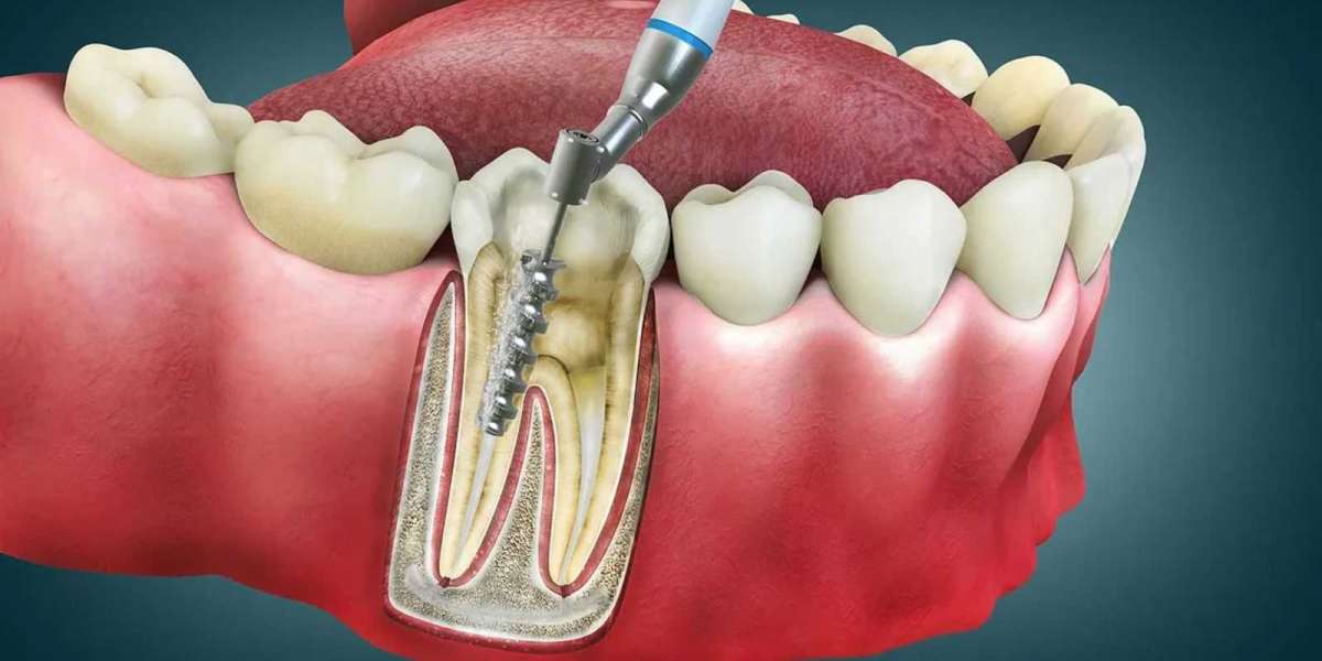 Scaling and Polishing in Dubai Bad Breath Solution Guide