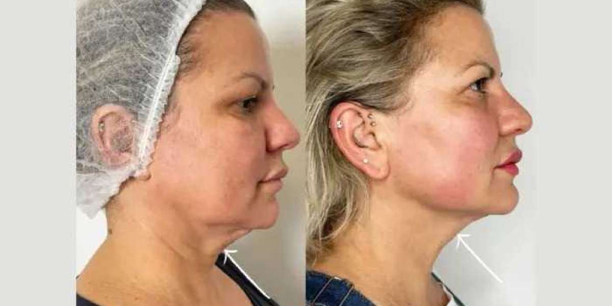 Best Doctors in dubai improving neck tightening with Endolift treatments