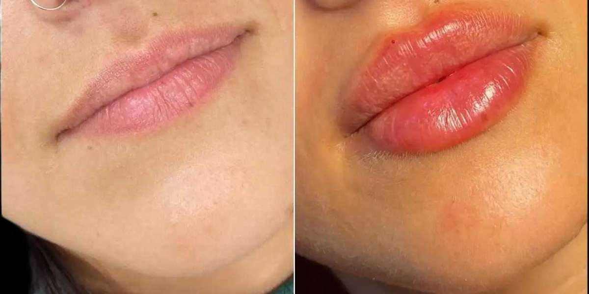 Fillers in Dubai Enhancing Confidence Through Aesthetics