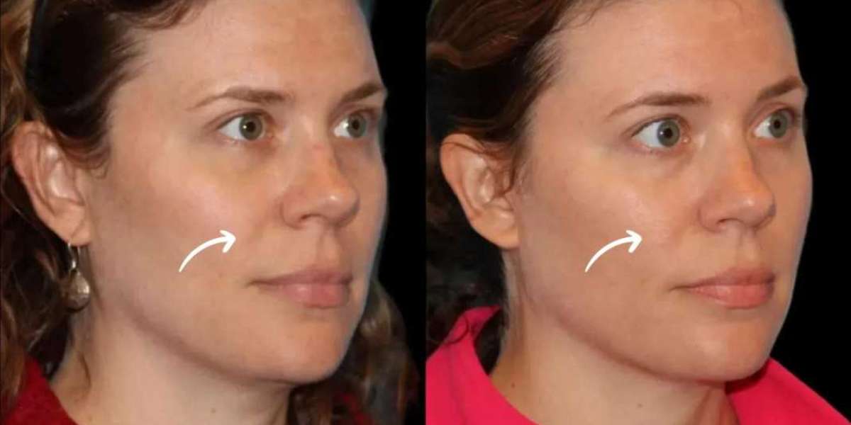 Best Plastic Surgeons in Dubai Use Sculptra Fillers for Rib Area Skin