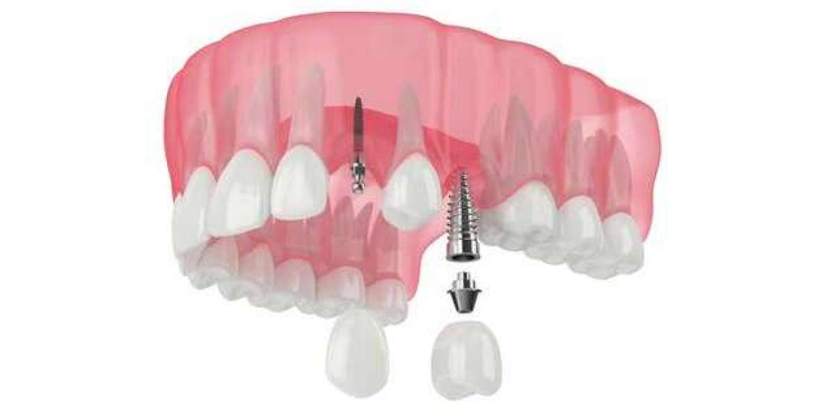 Dental Implants In Murphy - 10 Powerful Benefits You Should Know