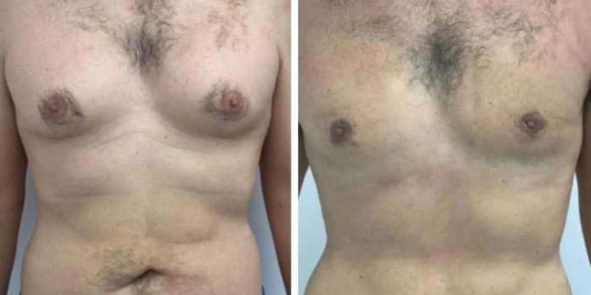 Comparing Techniques Used by the Best Gynecomastia Surgeon in dubai