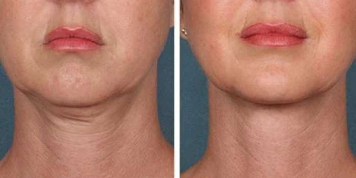 Best Plastic Surgeon in Dubai Powering Adaptive PRP Treatment Solutions