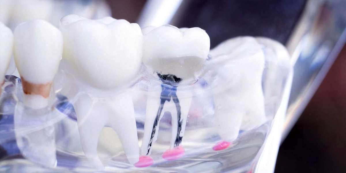 Dental tooth filling: Common Dental Procedures