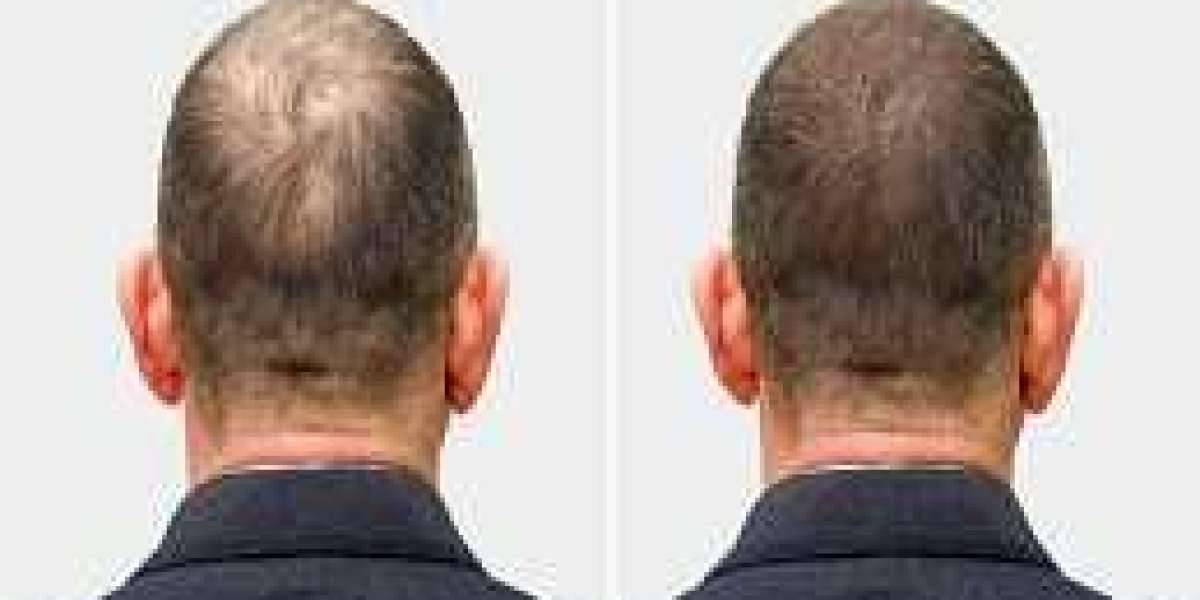 استثمارك الأذكى: تكلفة زراعة الشعر في دبي لنتائج مدى الحياة