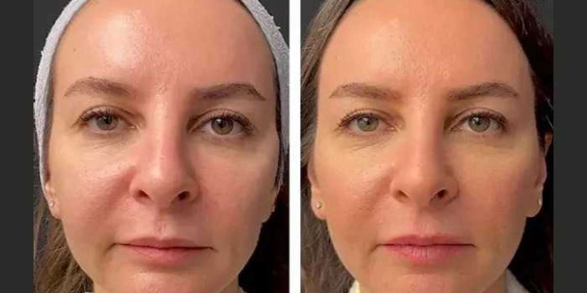 Mesotherapy Treatments in Dubai: Collagen Boosting Benefits
