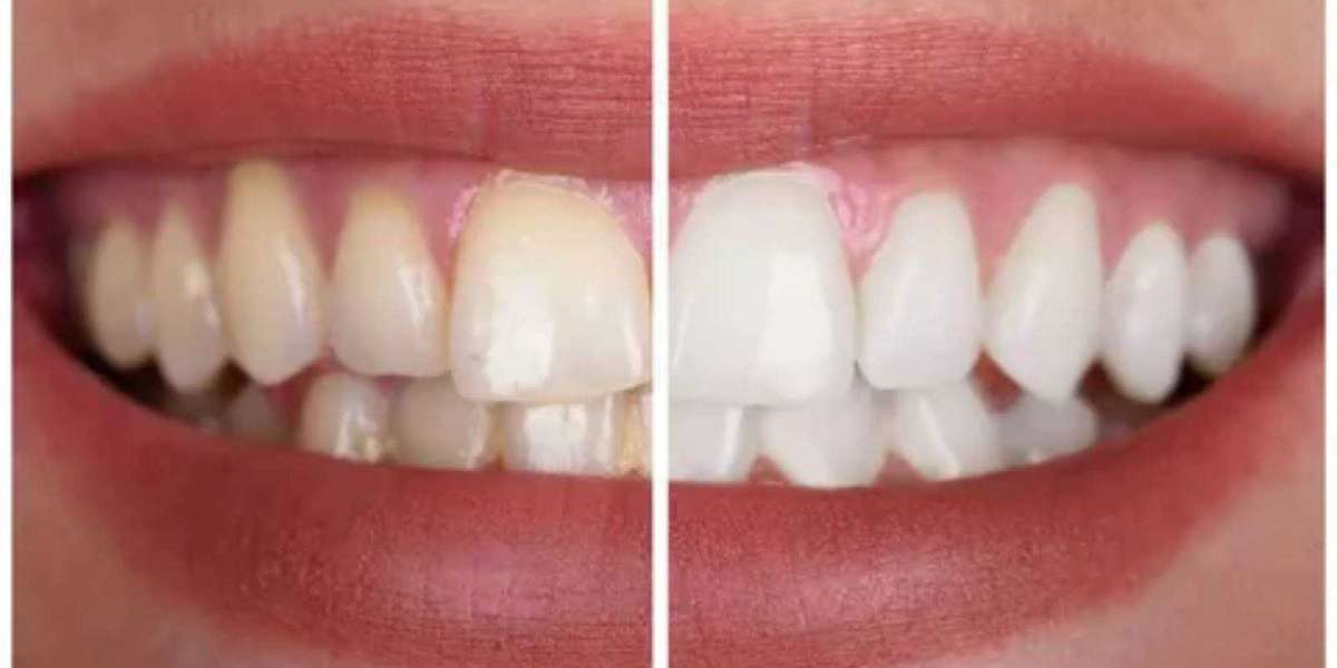 Why Choose Scaling and Polishing in Dubai Clinics