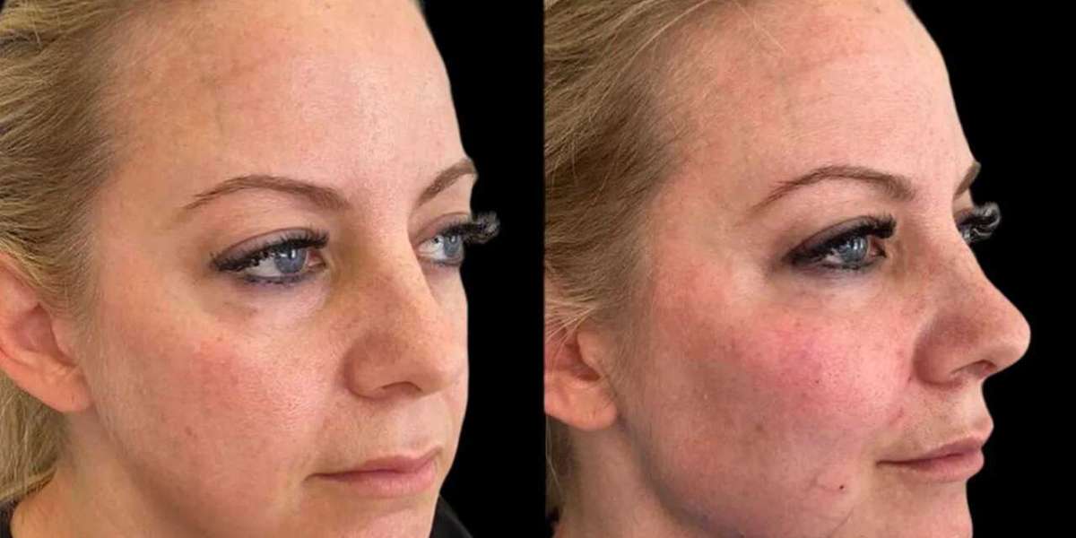 Cheek Fillers in Dubai Everything You Need Today