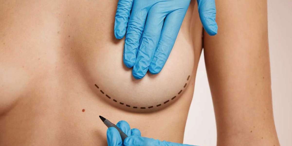 Can Breast Lift in Dubai Correct Uneven Breasts?