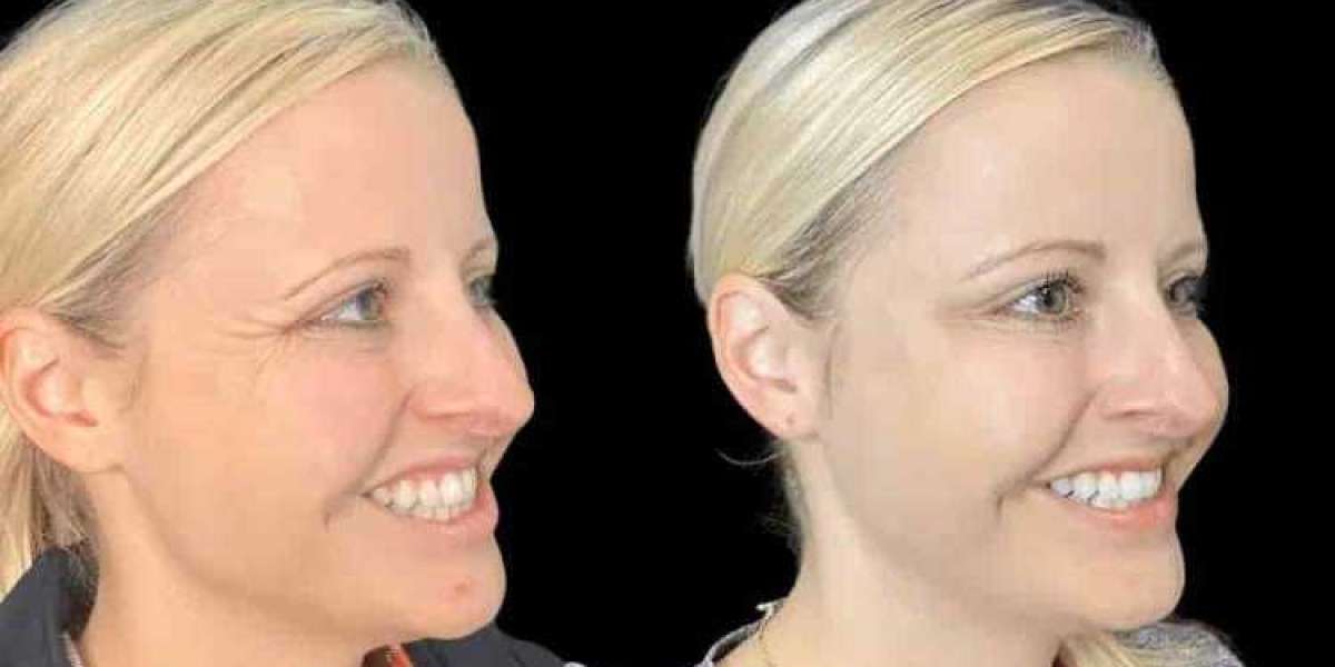 Botox in Dubai for Smooth Skin and Facial Harmony