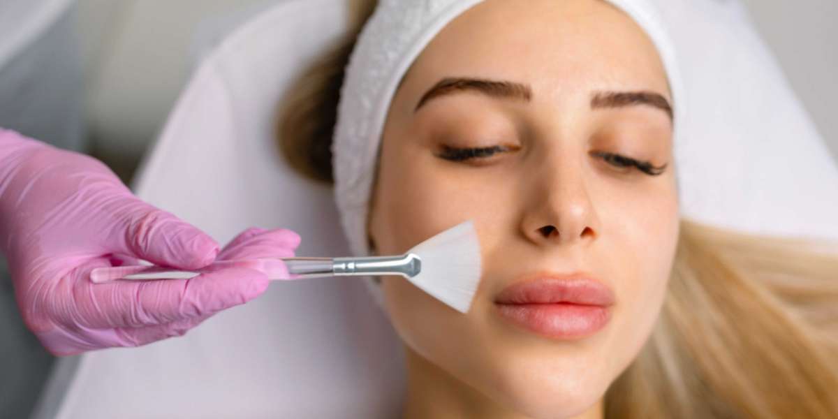 Can Chemical Peels Help with Large Pores?