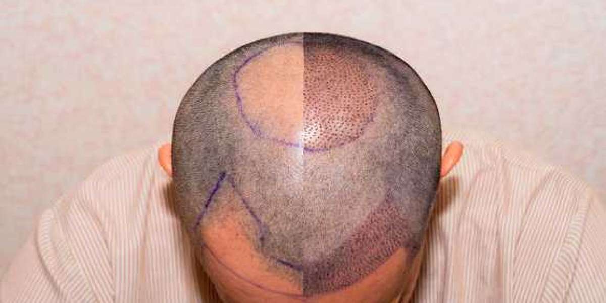 وداعاً للصلع: كيف تجعل تكلفة زراعة الشعر في دبي استثماراً ناجحاً؟