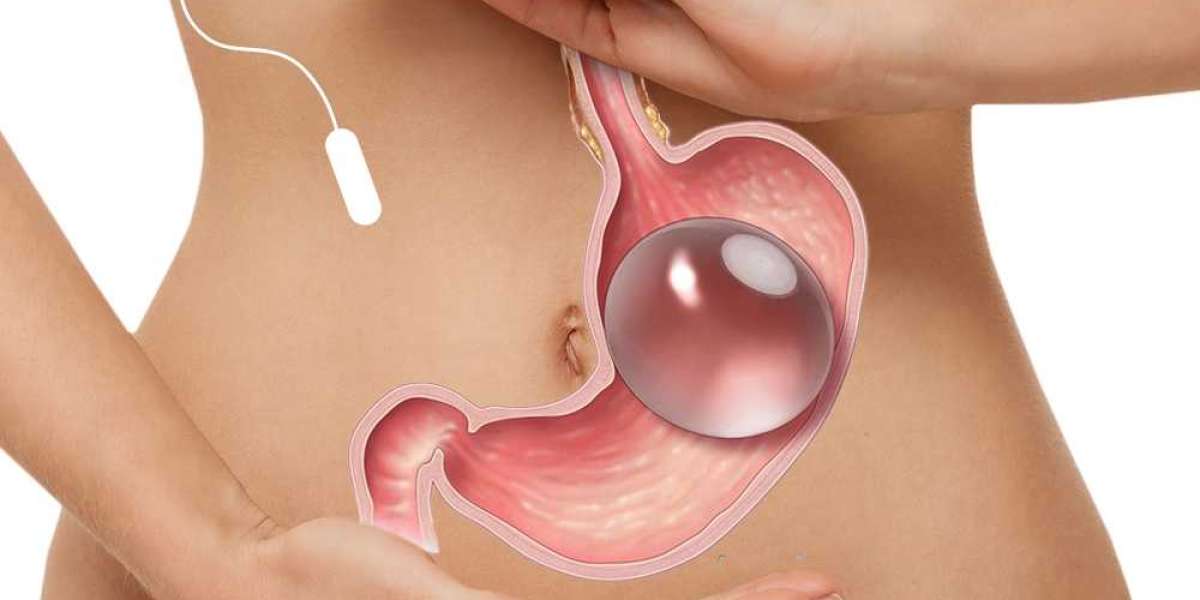 Why does Allurion Gastric Balloon Clinic help achieve ideal body shape?