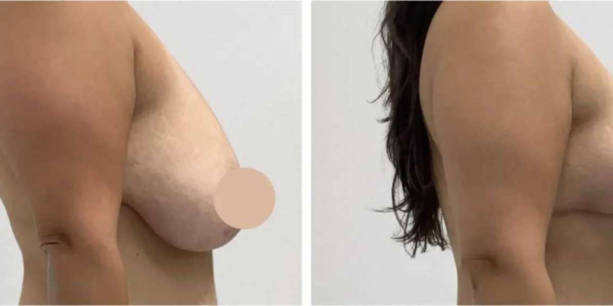 Best Breast Lift Surgeons in Dubai for Proven Before and After Results