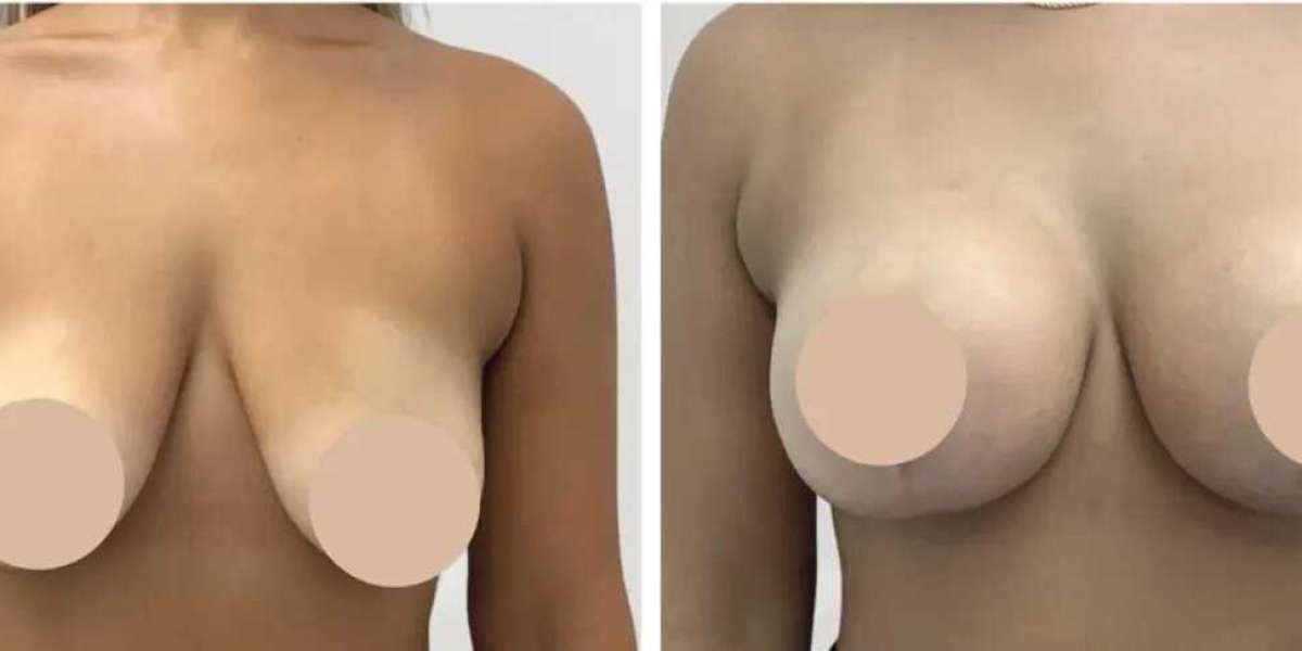 How Best Breast Reduction Surgeons in dubai Create Natural-Looking Results