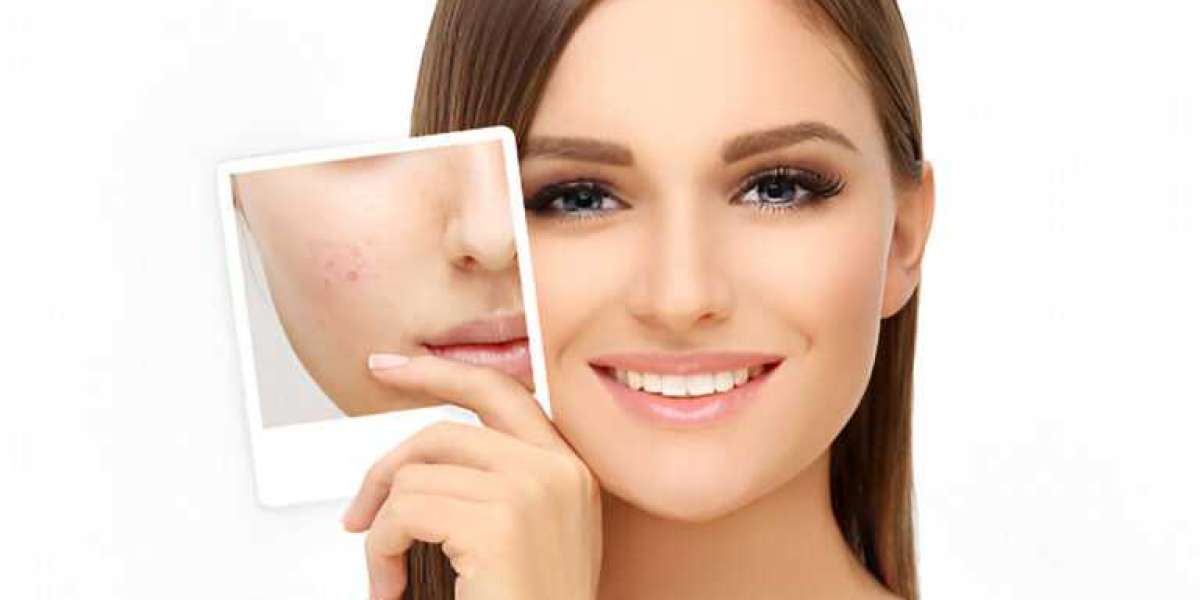 Clear Skin Journey Starts Here: Complete Guide to Acne and Scar Treatment in Navi Mumbai