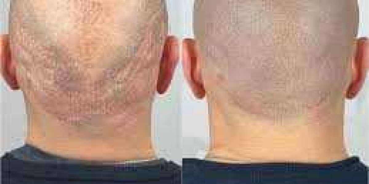 Best Hair Transplant Turkey: Scalp Micropigmentation vs Hair Transplant Comparison