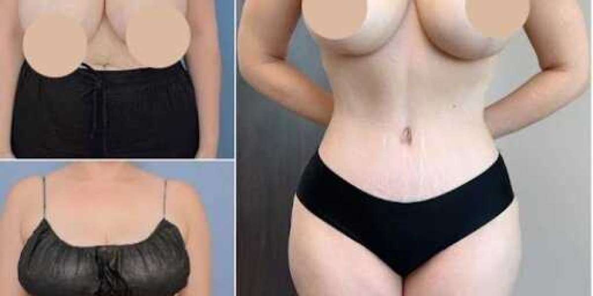 Tummy Tuck in Dubai: Expert Care for Lasting Results